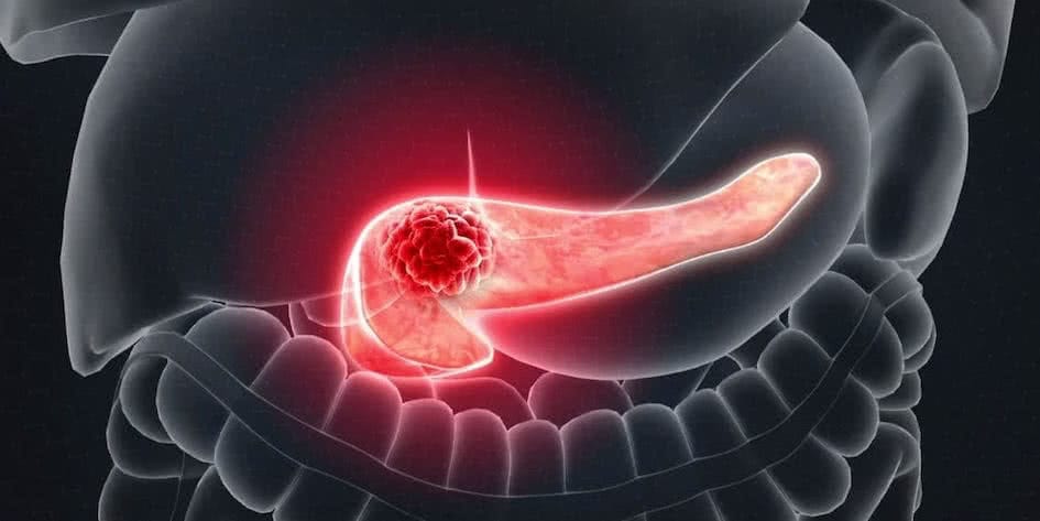 Панкреатический рак