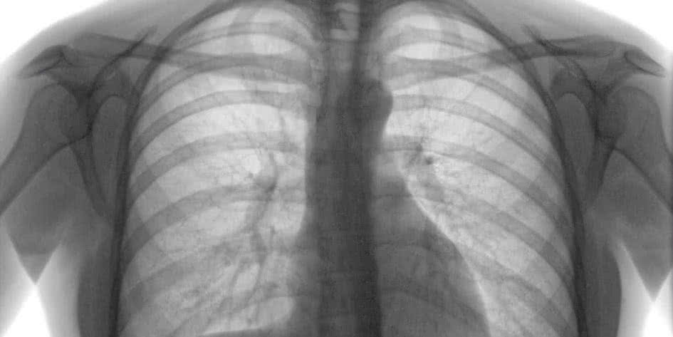 Tuberculosis Treatment Methods